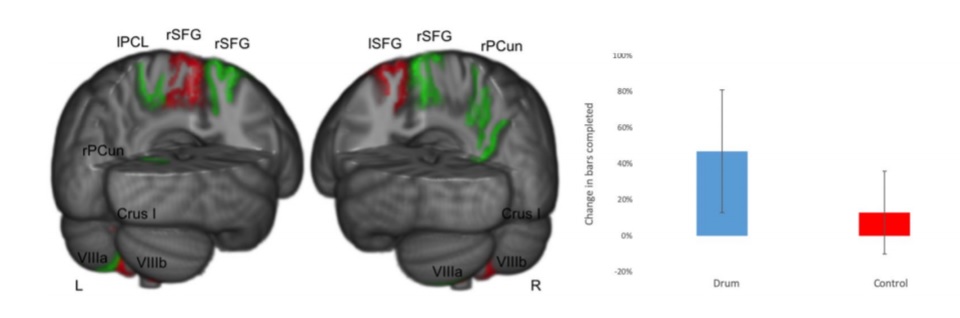 Increasing (green) and decreasing (red) cortical thickness and lobule volume before and after drum training 